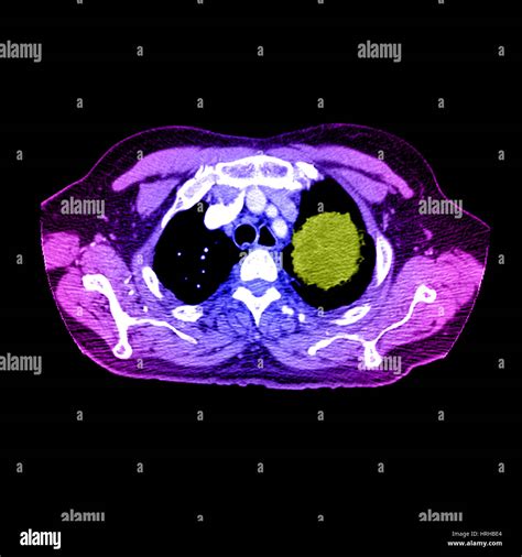 Chest Axial Ct Scan Hi Res Stock Photography And Images Alamy