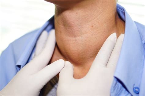 Single Radiofrequency Ablation Has Long Term Effects On Benign Thyroid