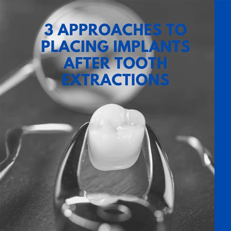 3 Approaches To Placing Implants After Tooth Extractions Digital