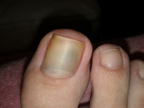 The color is not the same all over and may include different shades of brown or black, or sometimes with patches of pink, red, white, or blue. Black Spot Under Toenail Melanoma - Nail Ftempo