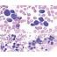 Plasma Cell Leukemia – Facts And Controversies More Questions Than 