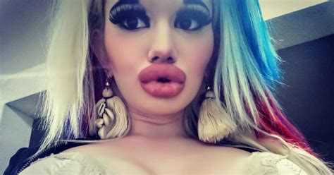 Woman Shares Photos Of Her Lips After 20th Acid Lip Injection Aiming For Biggest Lips In The