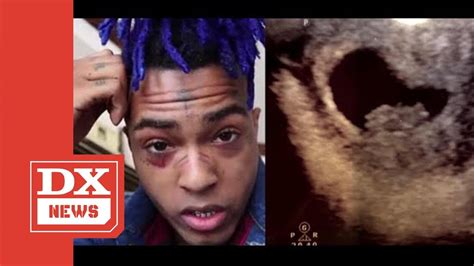 Xxxtentacion S Mother Posts Ultrasound Picture Revealing He Had A Baby
