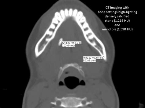 Salivary Ultrasound Sonopalpation For Stone Favorable For Transoral