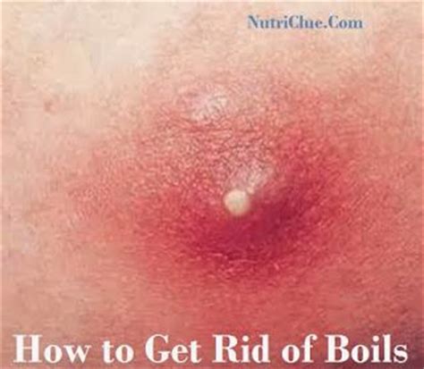 Maybe you would like to learn more about one of these? How to Get Rid of Boils | health remedies | Pinterest ...