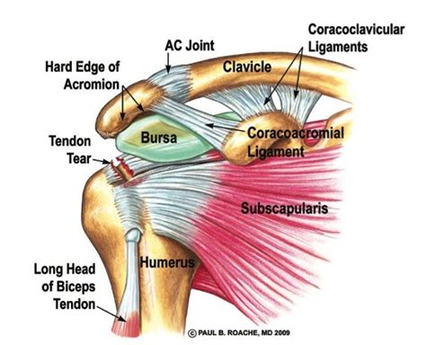 Shoulder Separationsac Joint Injuries Ligament Tear Bicep