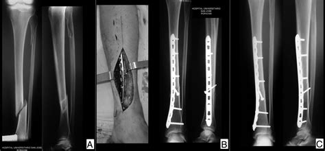 Management Of Diaphyseal Tibial Fractures By Plate Fixation With