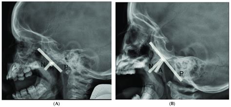 Lateral Cephalometric X Ray Findings A Nasopharynx Without Adenoid