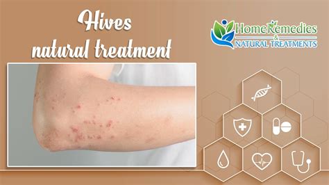Home Remedies For Hives How To Cure Hives Fast How To Cure