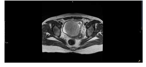 Figure 2 From Rare Case Presentation Of Leiomyoma Of Bladder Neck With