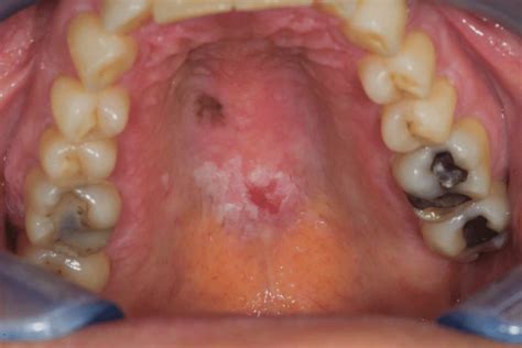 By special investigations it can be confirmed if the lump is cystic or solid, aspiration or biopsy is done and the material is sent to the laboratory. Hard palate view showing both in situ and invasive ...