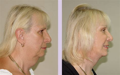 dr chettawut sex reassignment and facial feminization surgery center face lift and neck