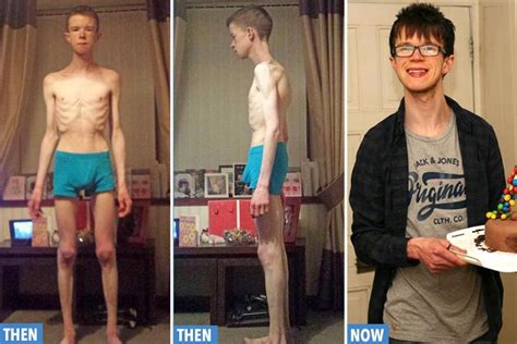 Anorexic Male Student Who Was Close To Death After Surviving On 1200