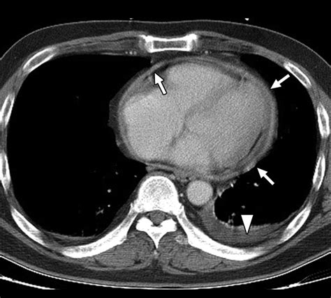 Ct Findings In Patients With Pericardial Effusion Differentiation Of