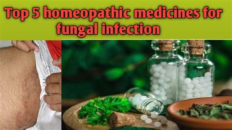 5 Best Homeopathic Medicines For Fungal Infection Homeopathic Treatment Best Tinea Cruris का