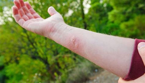Identify Treat Insect Bites Stings Australia Wide First Aid