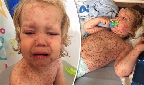 Toddler With Worst Chickenpox Doctors Had Ever Seen Was Turned Down For