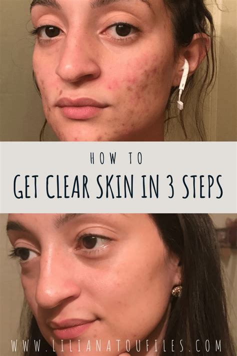 How To Get Clear Skin In 3 Steps Clear Skin Skin Beauty Inspiration
