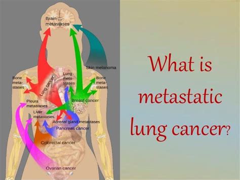 What Is Metastatic Lung Cancer