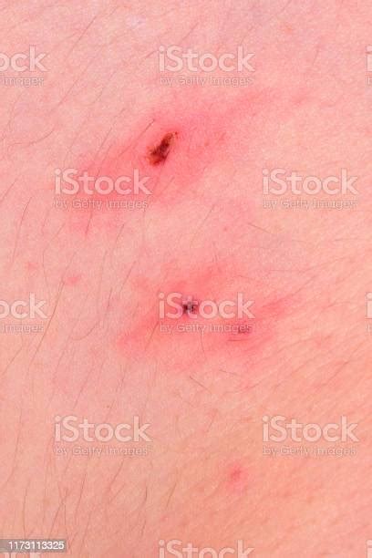 Tick Bites On Hairy Human Skin With Red Scabs Forming At Each Center