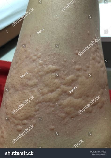 Prickly Heat Heat Rash Sudamina Urticaria Stock Photo 1205286808