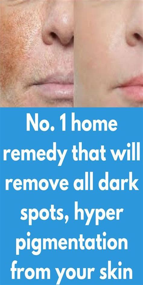 No 1 Home Remedy That Will Remove All Dark Spots Hyper Pigmentation
