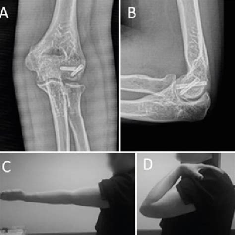 Post Operative Ap And Lateral Radiographs A B And Images From Final