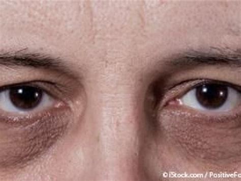 What Causes Dark Circles Under The Eyes Ramsey Nj Patch