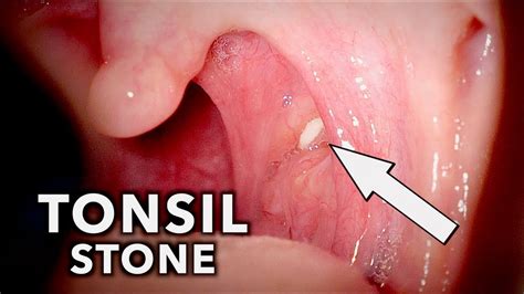 Tonsil stones, also known as tonsilloliths, are mineralizations of debris within the crevices of the tonsils. TONSIL STONE + A Touch of Pneumonia | Dr. Paul - YouTube
