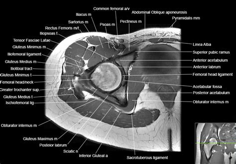 Axial Hip Mri Anatomy