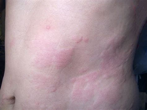 How Tell If Your Rash Is Contact Dermatitis Eczema Psoriasis Or Hives