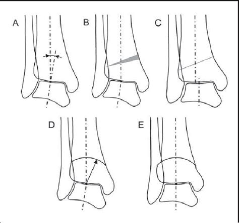 Figure 4 From The Use Of Osteotomies In The Treatment Of Asymmetric