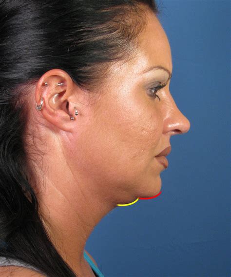 Double Chin Surgery Liposuction In San Diego Ca Dr Hilinski