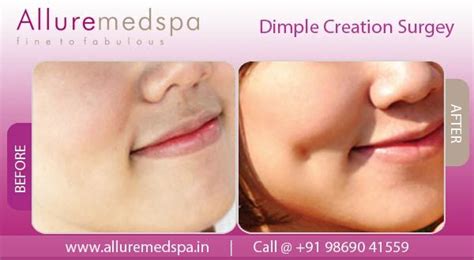 Dimple Creation Before And After Photos In India Dimples Cosmetic
