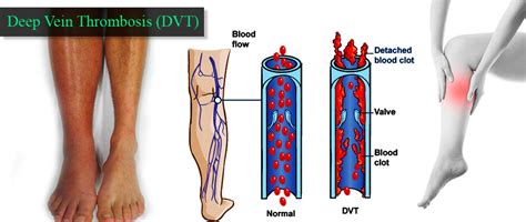Deep Vein Thrombosis Dvt Treatment And Prevention