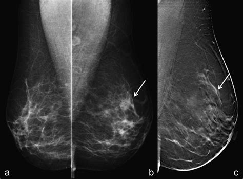 Impact On The Recall Rate Of Digital Breast Tomosynthesis As An Adjunct