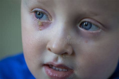 Child With Purulent Conjunctivitis Contagious Eye Infection Symptoms