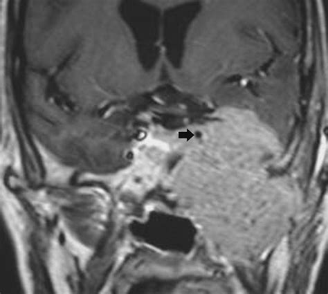 Imaging Lesions Of The Cavernous Sinus American Journal Of Neuroradiology