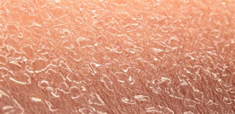 Dry Flaking Skin Symptoms Causes And Common Questions Buoy