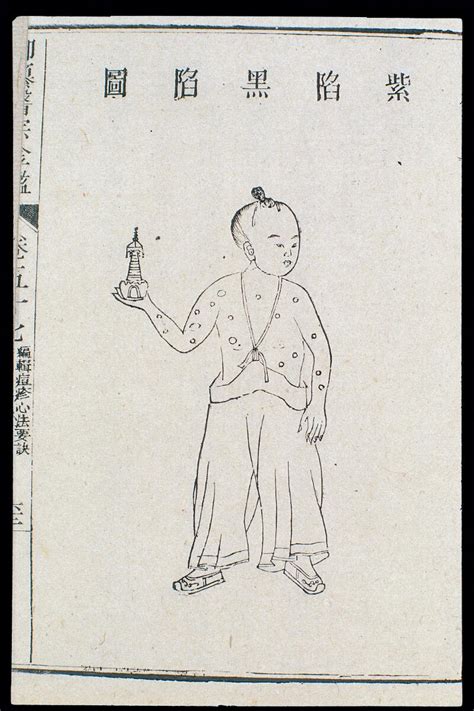 Chinese C18 Paediatric Pox Purple And Black Indentations