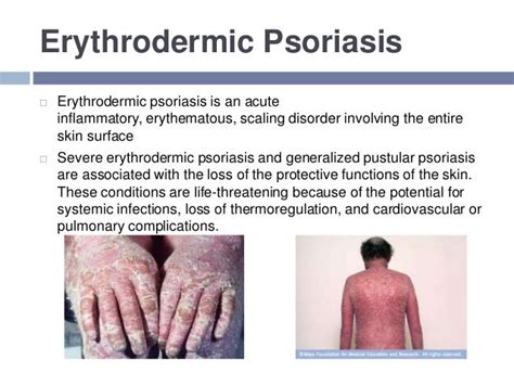 Psoriasis And Scabies By Manaswi