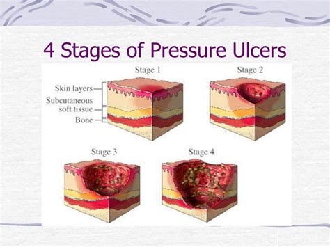 Ppt Pressure Ulcers Aka Bedsores Powerpoint Presentation Free Images