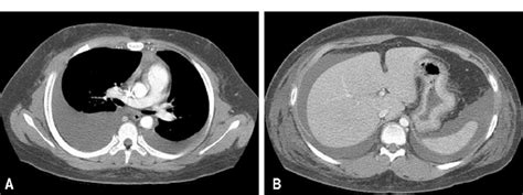 Initial Chest Ct Scan Showed Large Amounts Of Pleural Effusion At Both