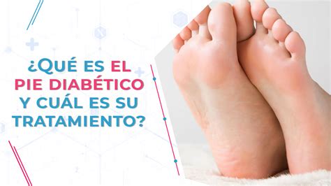 Qué es el pie diabético y cuál es su tratamiento