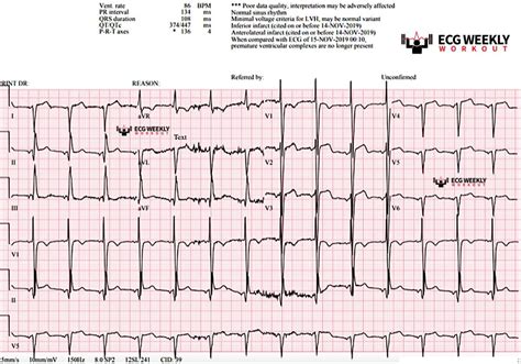 STAT ECG Diagnoses The Right Way To Think About Right Axis Deviation