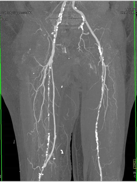 Peripheral Vascular Disease Pvd With Extensive Left Superficial