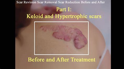 Part I Keloid And Hypertrophic Scars Before And After Treatment Youtube