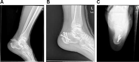 Figure 1 From The Treatment Of Avulsion Fracture Of The Calcaneal