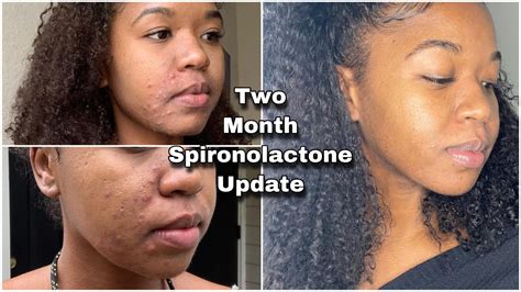 Hormonal Acne Journey Spironolactone Month 2 Update Youtube