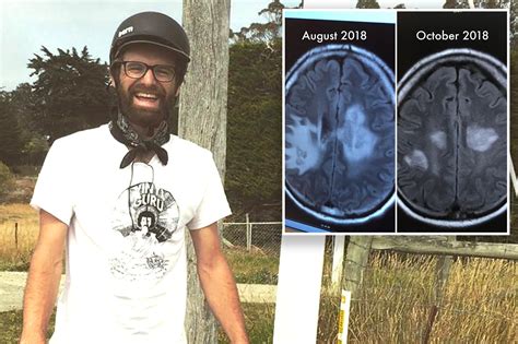 Man Suffering From Rare Toxic Black Mold Growing On His Brain After